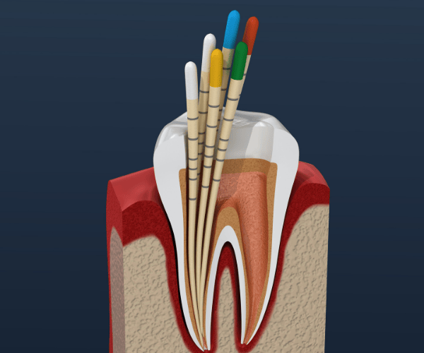 Endodontic Treatments
