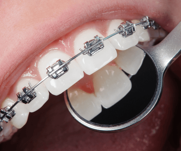 Orthodontic Treatments